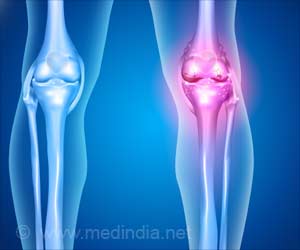 New Model of Understanding Osteogenesis Imperfecta