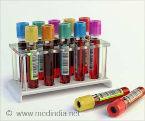 Blood Test Predicts the Effect of Palbociclib Drug on Breast Cancer Patients

