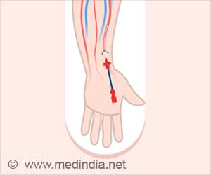 Comparing Distal Vs Proximal Radial Artery Access: Findings Show Promising Results