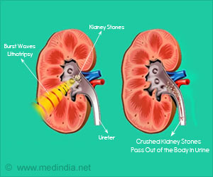 Kidney Stones Zapping Technology by NASA to Help Treat Astronauts With Stones