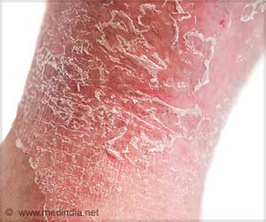 Histone Deacetylase Inhibitors: Cancer Therapy Offers Hope in Psoriasis Treatment
