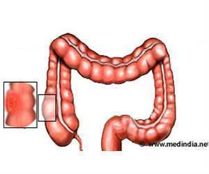Why Colon Cancer Strikes Younger Indians?