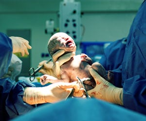 Twins Born by C-section Had Lower Cognitive Development