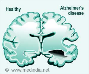 Alzheimer's Disease Vaccine is on the Way