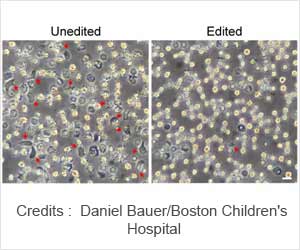 Positive Gene Editing for Sickle Cell Disease and Beta Thalassemia