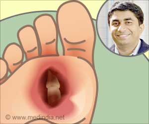 Diabetic Foot Syndrome Management