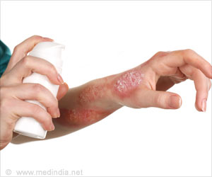 US FDA Nod for Psoriasis Spray by Dr Reddy's