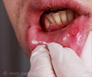 Factors Behind the Rise of Oral Cancer in India Revealed