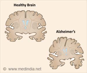 World's Youngest Case of Alzheimers Disease