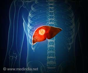  Primary Liver Cancer: Guide for Hepatocellular Carcinoma