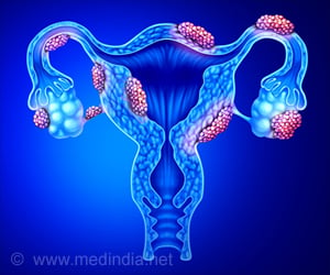 Are Women With Endometriosis at Risk of Stroke?