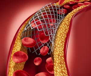 Genetic Test may Enhance Outcomes in Heart Stent Patients