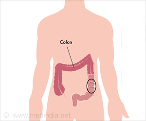 Diabetes Patients With Reduced GLUT4 Expression in NK Cells may be at High Colon Cancer Risk