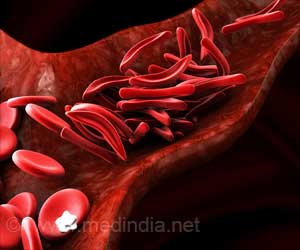 L-glutamine Approved for Sickle Cell Disease