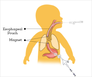 FDA Authorizes First Medical Device for Esophageal Birth Defect in Babies