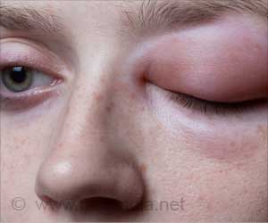 Lanadelumab's Benefit Not Proven in Hereditary Angioedema