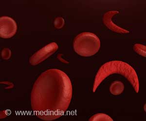  Sickle Cell Treatment: FDA Approves Gene Therapies for Recurrent Vaso-Occlusive Crises