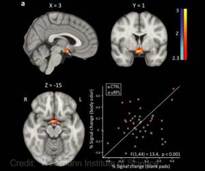 Repeated Pregnancy Loss Linked to Olfactory System