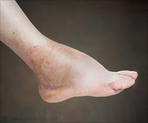 Foot and Ankle Swelling Could Lead to Heart Disease