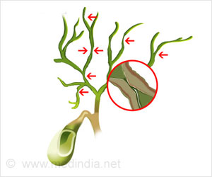Four New Genes May Increase Risk of Primary Sclerosing Cholangitis