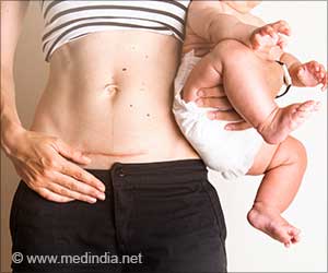 Alarming Cesarean Section Trends in India - Convenience or Compulsion of Corporate Healthcare Alarming Cesarean Section Trends in India - Convenience or Compulsion of Corporate Healthcare