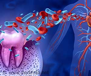 Oral Bacteria May Be the Hidden Trigger Behind Heart Attacks