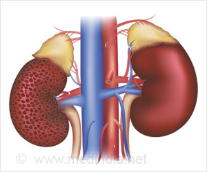 Diabetic Drugs Delay Chronic Kidney Disease Progression