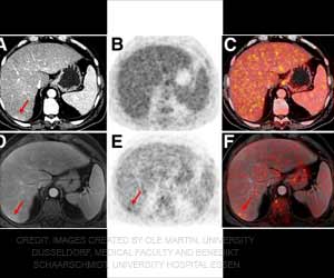 PET/MRI Better Than PET/CT in Cancer Detection