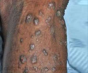 New Insights into Itchy Skin Condition