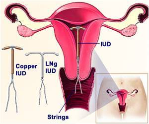  Early Versus Delayed Use of IUD Post First Trimester Abortion - Which is Better?
