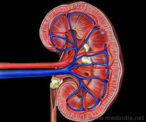  New Discovery for Urinary Tract Infections and Kidney Stones