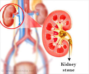 Kidney Stones can be Tackled With Drug Used To Treat Enlarged Prostate