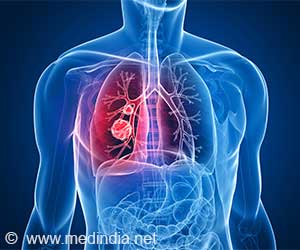  World's First Experimental Lung Cancer Vaccine Enters Clinical Trials