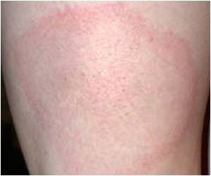 New Research Aims to Improve Lyme Disease Diagnostics