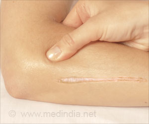 Scars, Keloids & Dupuytren Contracture can be Prevented by Enzyme LOX