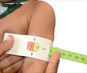 Assessment of Acute Malnutrition Among Children