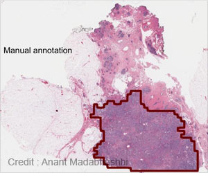 Computer Accurately Describes Breast Cancers on Digital Tissue Slides Computer Accurately Describes Breast Cancers on Digital Tissue Slides
