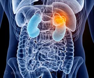 Belly Fat Matters for Female but Not Male Kidney Cancer Patients