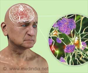 First Ever Medically-Acquired Alzheimers Disease Reported