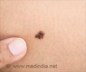 Melanoma Treatment - New Investigational Drug Shows Promise in Early Phase I Clinical Trials