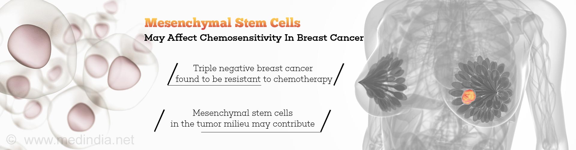 Chemo-resistance in Triple Negative Breast Cancer Linked To Mesenchymal Stem Cells In Tumor