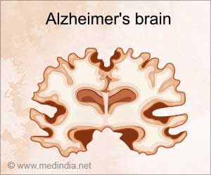 Novel Sensor for Early Detection of Alzheimer's Disease