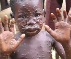 Treating Monkeypox With Antiviral Drugs Might be Effective