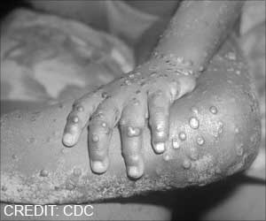 Monkeypox: Man in Tamil Nadu With Skin Rash Kept in Isolation