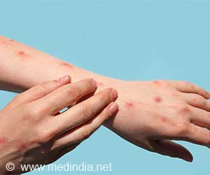 WHO Declares End to Mpox Emergency But Warns of African Surge