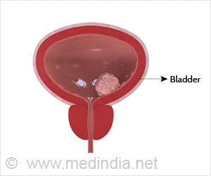 Urine Test Helps Detect Bladder Cancer Recurrence