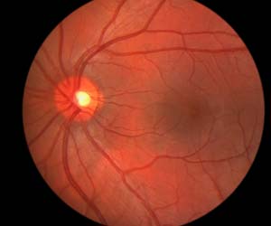 New Target for Diabetic Retinopathy Found
