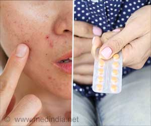 Oral Contraceptive Pill  can Keep Your Acne Still!