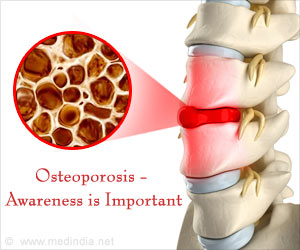 New Medication Helps Treat Osteoporosis