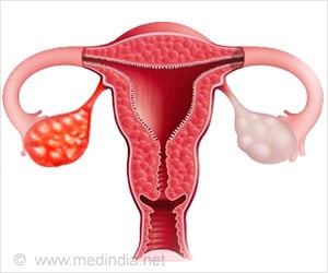 Hormonal Maintenance Therapy Improves Survival Rate in Ovarian Cancer